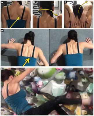 Case Report: Using Telehealth to Treat Triceps Tendinopathy in a Rock Climber